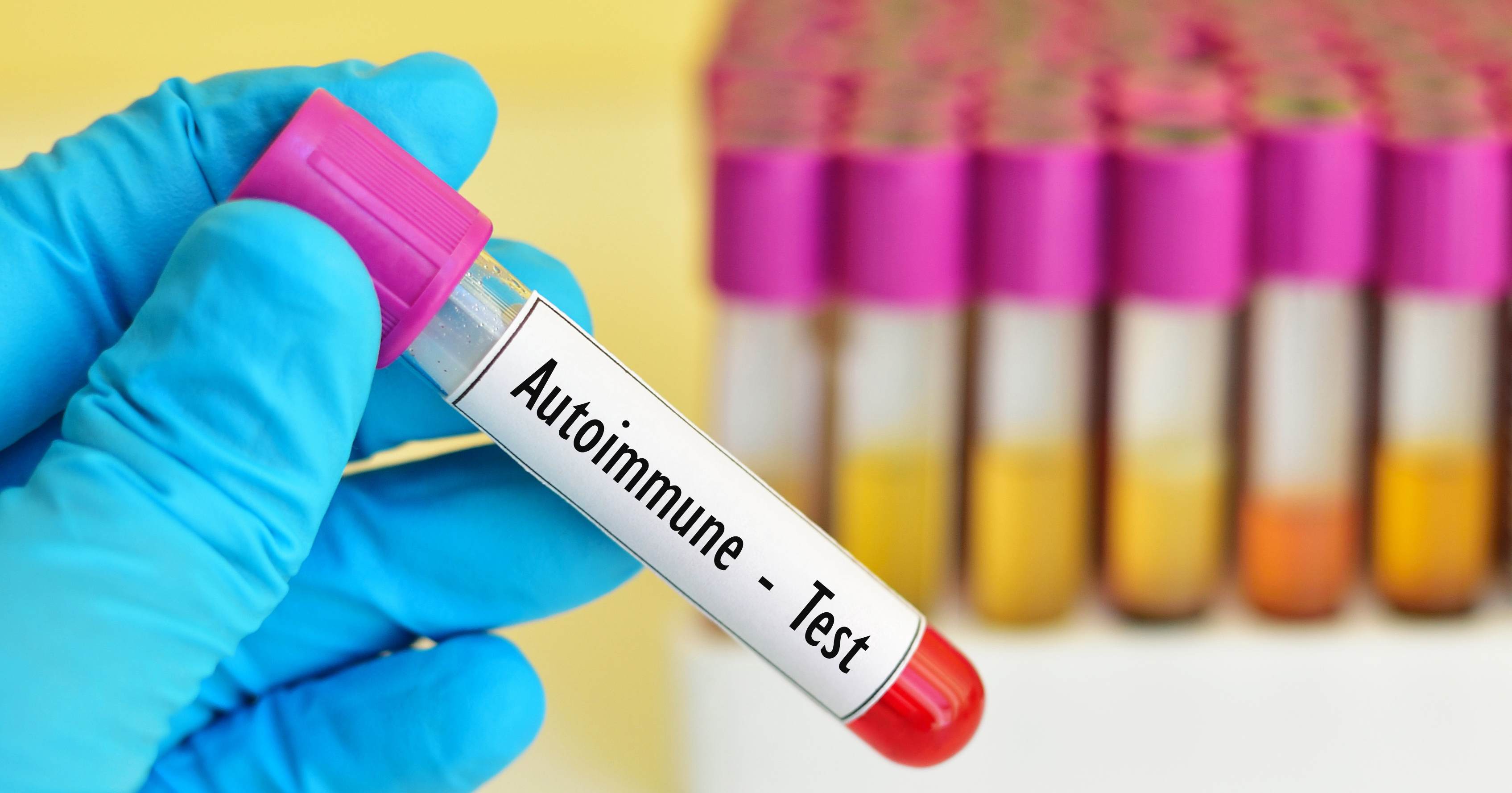 Test per malattie autoimmuni