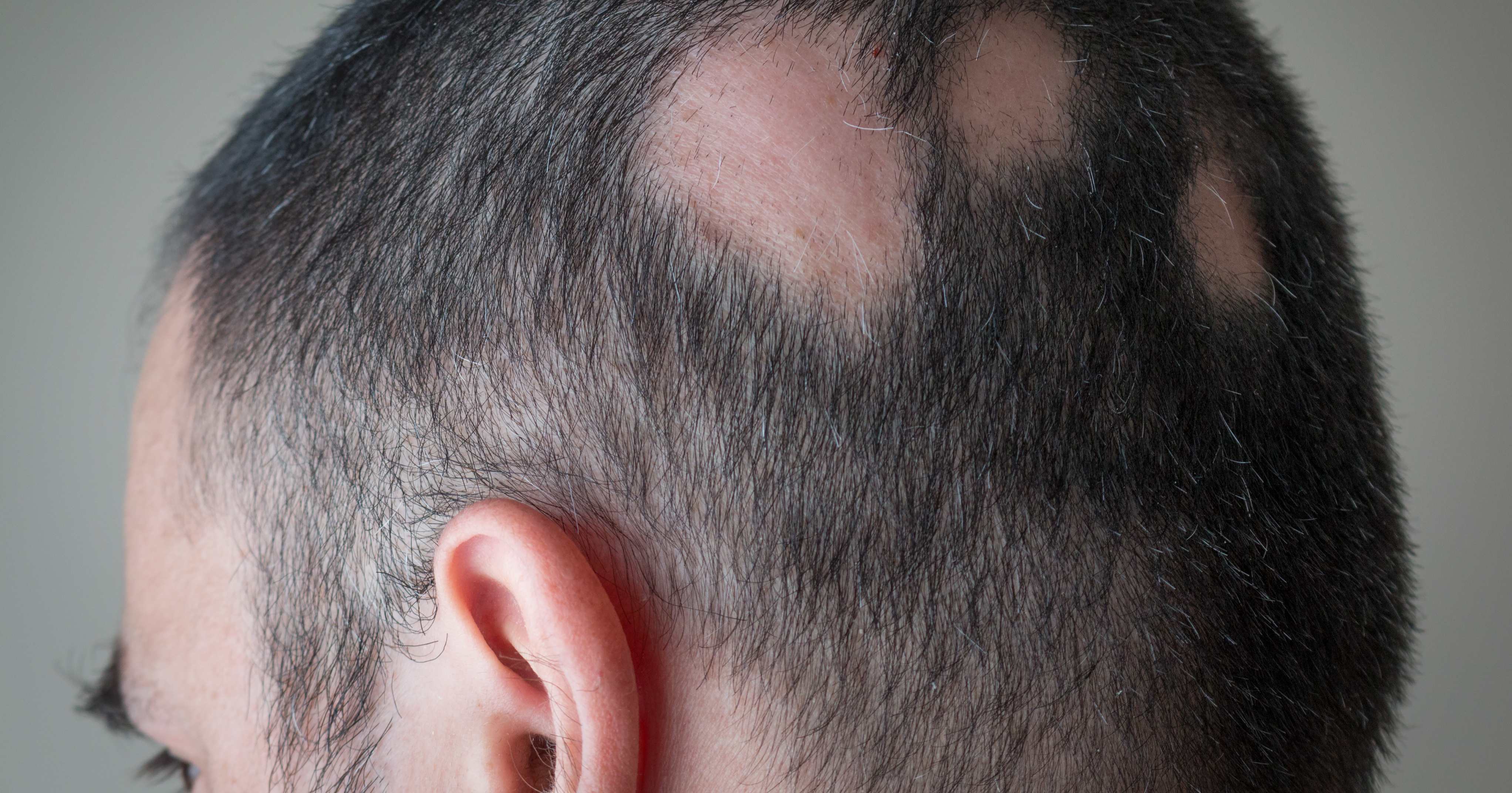 Alopecia a chiazze