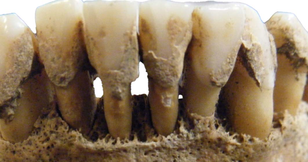 dental calculus archaeology